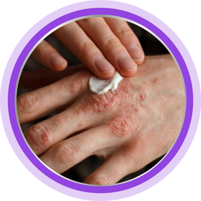 Person applies cream to eczema on their hands