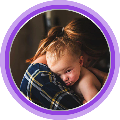 Mum holding baby with eczema on its face