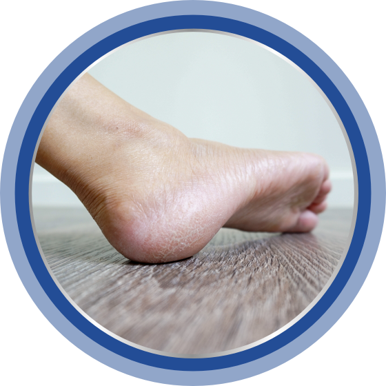 Dry and chapped skin on a foot